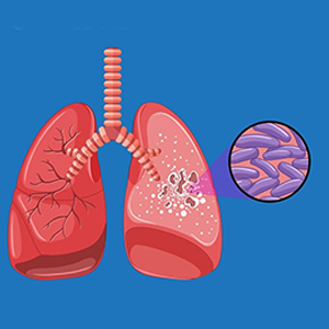 Tuberculosis
